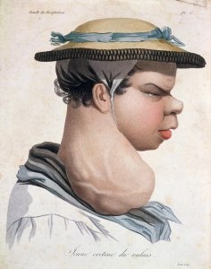 Young Cretin from Valais, illustration from a book by Baron Jean Louis Alibert 1768-1837