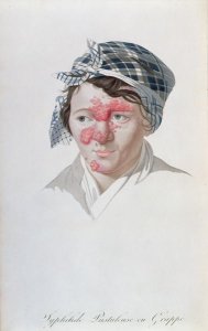 Syphilic cluster pustules, from a book by Baron Jean Louis Alibert 1768-1837 1838