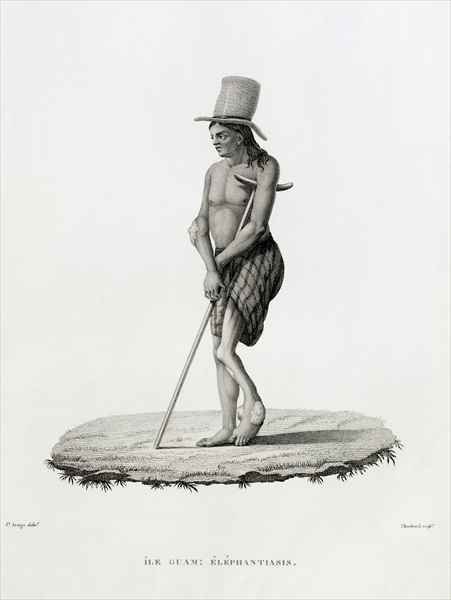 Guam: A Man with Elephantiasis, from 'Voyage Autour du Monde sur les Corvettes de L'Uranie 1817-20'